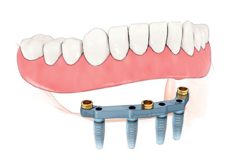 Implant Supported Dentures: A Modern Solution for Lasting Comfort