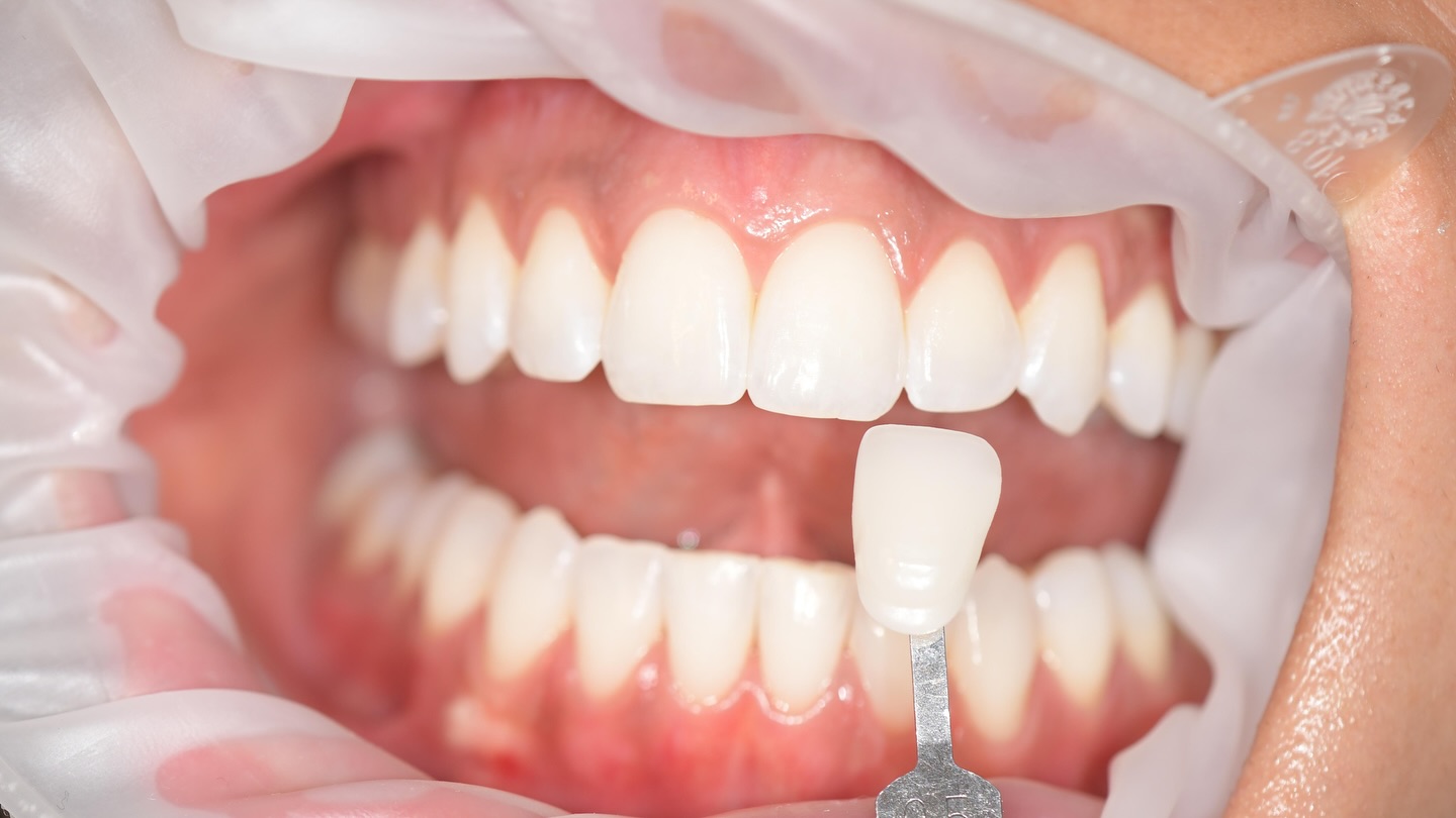 Sparking white teeth, recently whitened