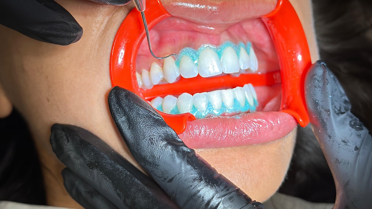 Teeth Whitening: First Considerations